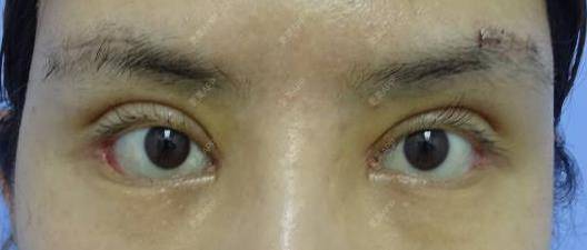更美 - 更美用户t7ZLrifwYB的膨体垫眉弓经验 | 膨体垫眉弓 | 垫眉弓 | 硅胶垫眉弓 | 重庆