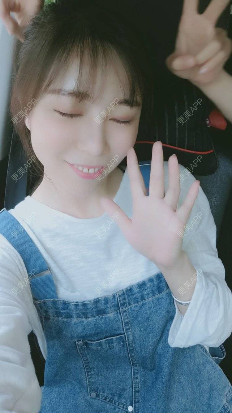 更美 - hu7676的太阳穴经验 | 视频日记 | 武汉 | 玻尿酸太阳穴 | 自体脂肪丰太阳穴 | 硅胶丰太阳穴 | 膨体丰太阳穴 | 太阳穴 | 胶原蛋白丰太阳穴