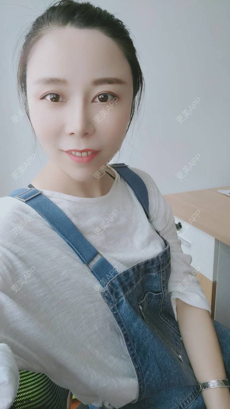 更美 - hu7676的太阳穴经验 | 视频日记 | 武汉 | 玻尿酸太阳穴 | 自体脂肪丰太阳穴 | 硅胶丰太阳穴 | 膨体丰太阳穴 | 太阳穴 | 胶原蛋白丰太阳穴
