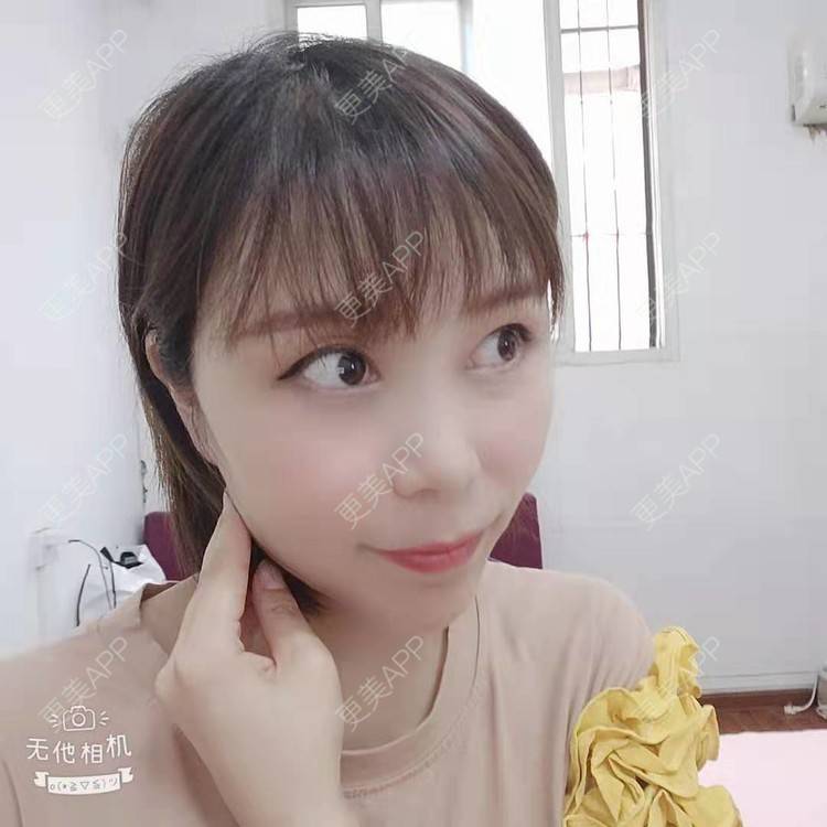 更美 - hu7676的太阳穴经验 | 视频日记 | 膨体丰太阳穴 | 武汉 | 自体脂肪丰太阳穴 | 玻尿酸太阳穴 | 硅胶丰太阳穴 | 太阳穴 | 胶原蛋白丰太阳穴