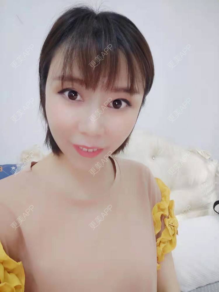更美 - hu7676的太阳穴经验 | 视频日记 | 膨体丰太阳穴 | 武汉 | 自体脂肪丰太阳穴 | 玻尿酸太阳穴 | 硅胶丰太阳穴 | 太阳穴 | 胶原蛋白丰太阳穴