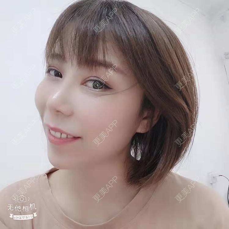更美 - hu7676的太阳穴经验 | 视频日记 | 膨体丰太阳穴 | 武汉 | 自体脂肪丰太阳穴 | 玻尿酸太阳穴 | 硅胶丰太阳穴 | 太阳穴 | 胶原蛋白丰太阳穴