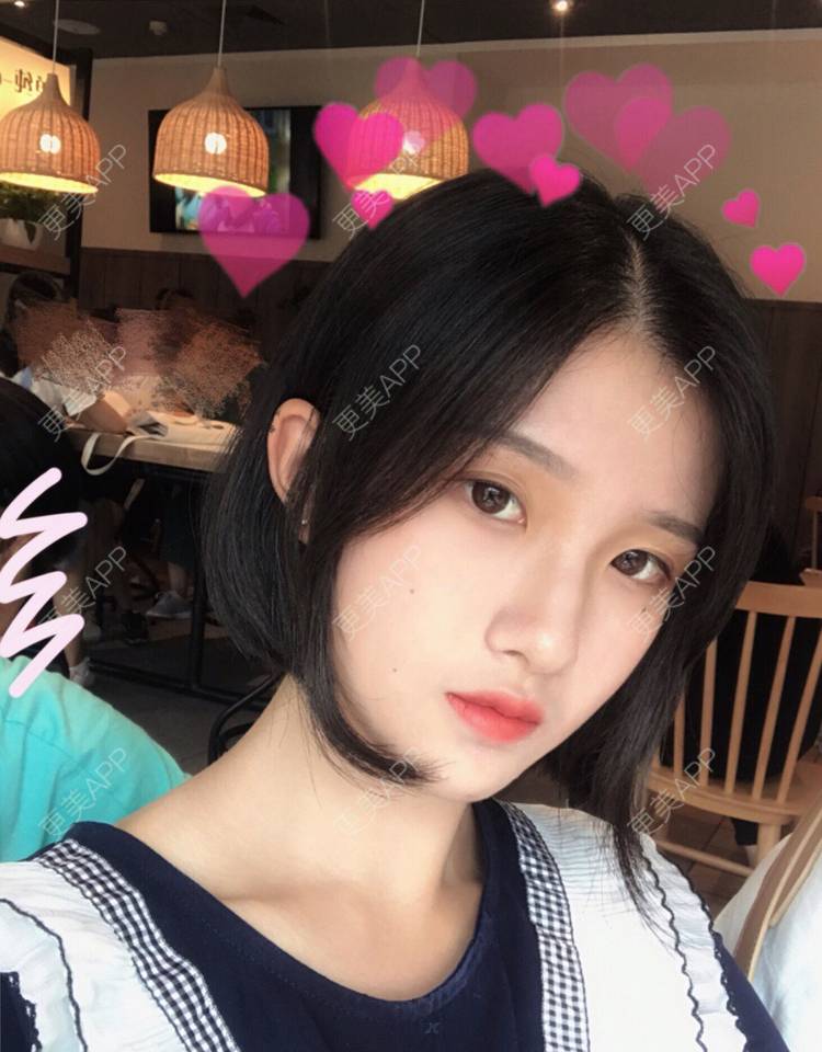 更美 - 罗兰儿的牙齿瓷贴面经验 | 成都 | 牙齿瓷贴面