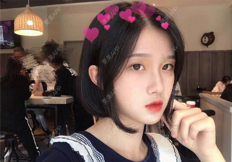 更美 - 罗兰儿的牙齿瓷贴面经验 | 成都 | 牙齿瓷贴面