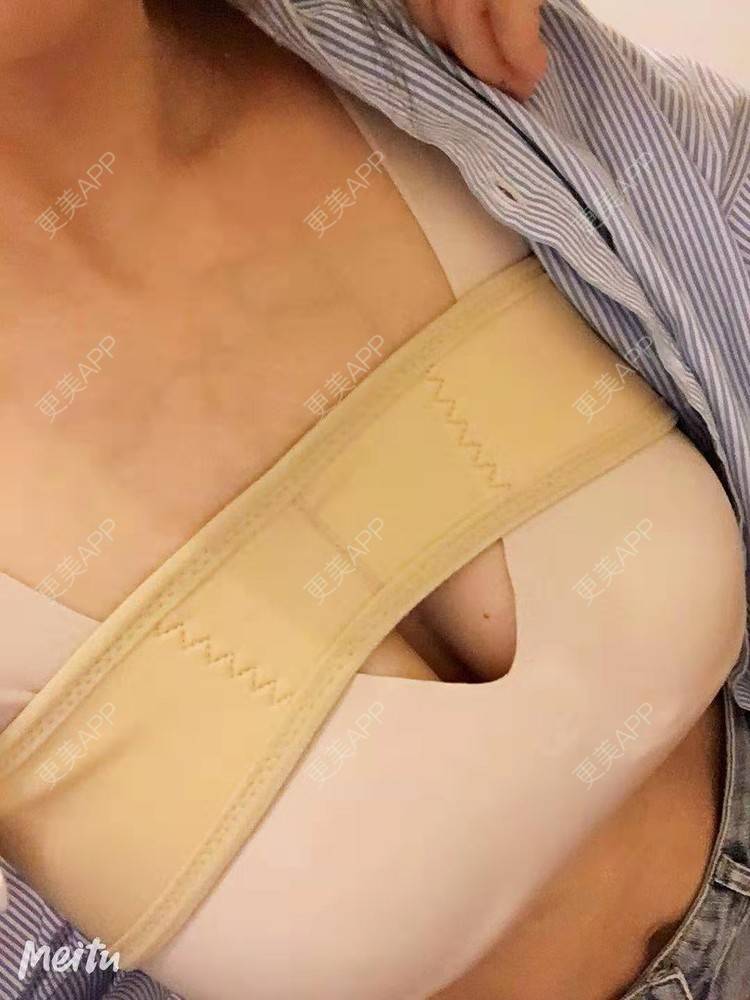 更美 - 更美用户SZx7fVhtiX的假体隆胸经验 | 假体隆胸 | 胸部下垂矫正 | 美胸套餐 | 重庆