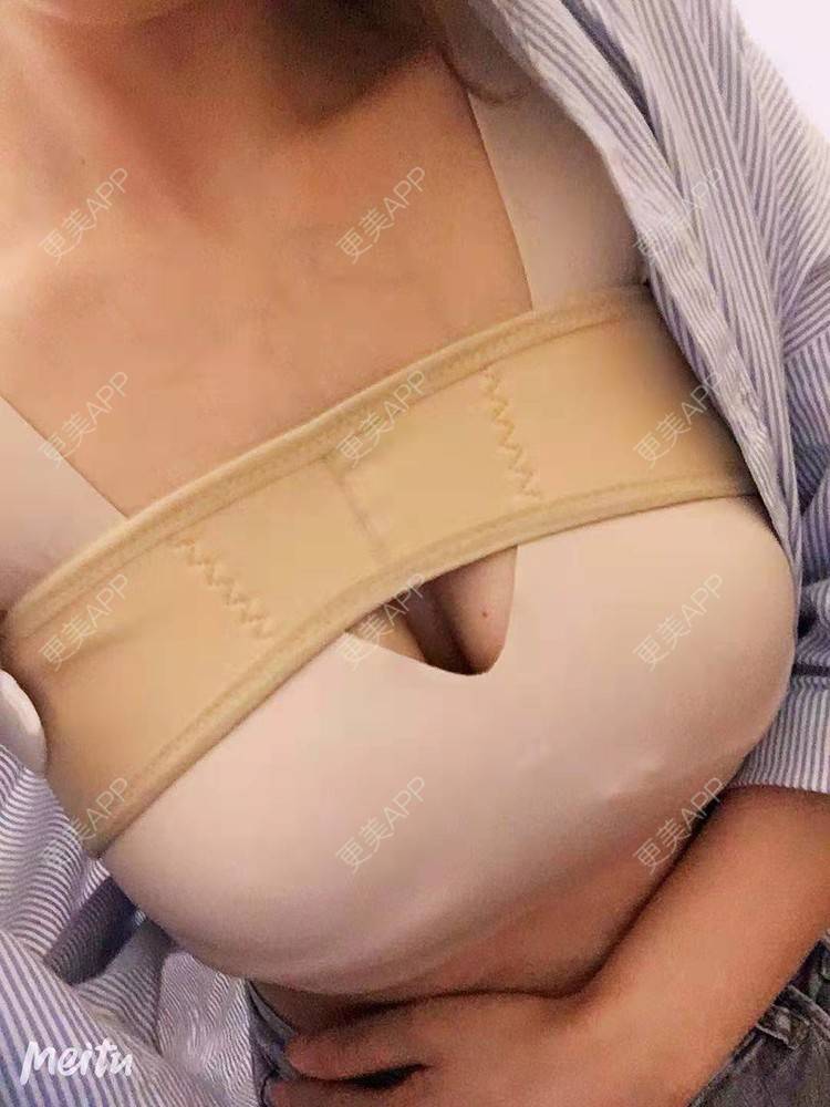 更美 - 更美用户SZx7fVhtiX的假体隆胸经验 | 假体隆胸 | 胸部下垂矫正 | 美胸套餐 | 重庆