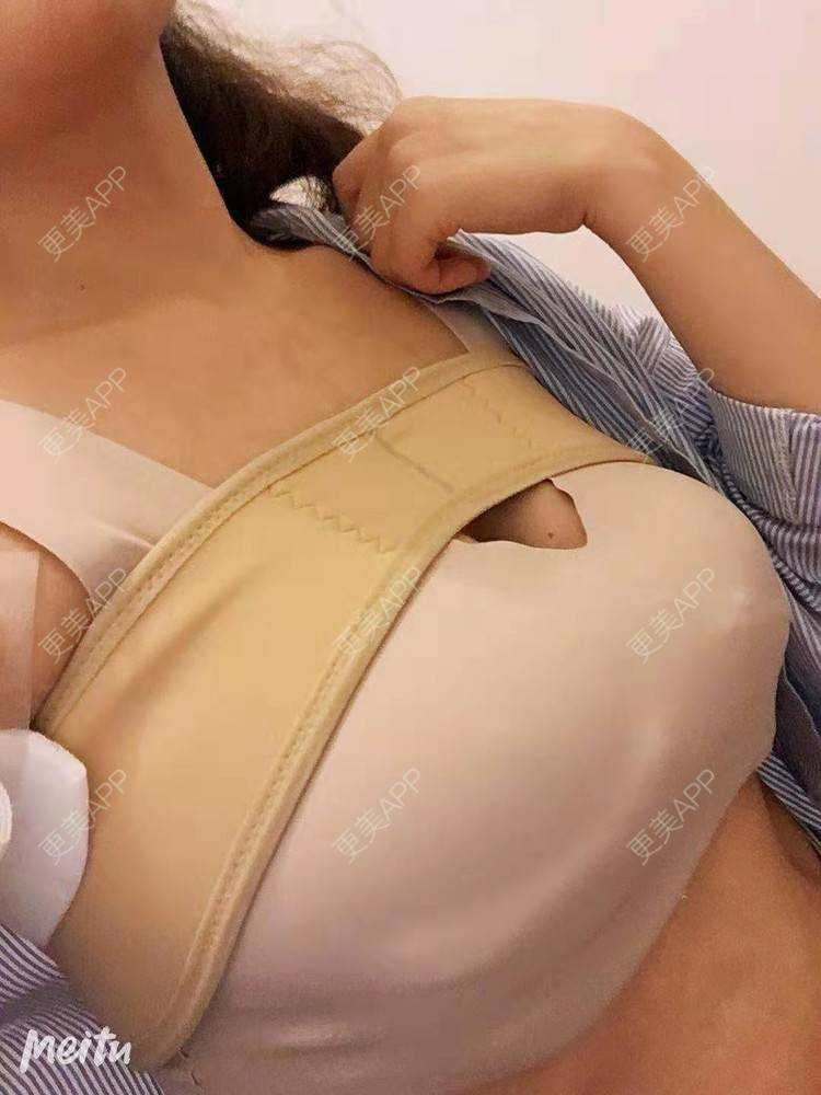 更美 - 更美用户SZx7fVhtiX的假体隆胸经验 | 假体隆胸 | 胸部下垂矫正 | 美胸套餐 | 重庆