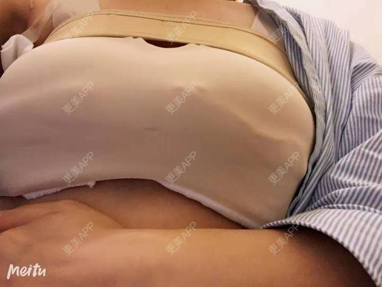 更美 - 更美用户SZx7fVhtiX的假体隆胸经验 | 假体隆胸 | 胸部下垂矫正 | 美胸套餐 | 重庆