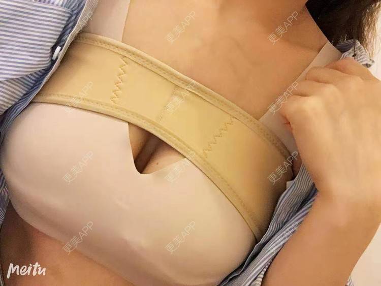 更美 - 更美用户SZx7fVhtiX的假体隆胸经验 | 假体隆胸 | 胸部下垂矫正 | 美胸套餐 | 重庆
