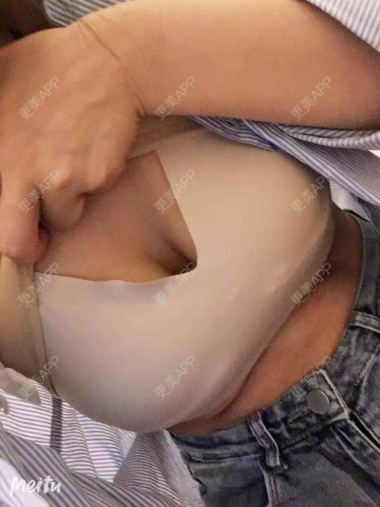 更美 - 更美用户SZx7fVhtiX的假体隆胸经验 | 假体隆胸 | 胸部下垂矫正 | 美胸套餐 | 重庆