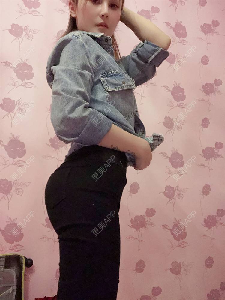更美 - 更美用户qJHH3yDtVZ的假体丰臀经验 | 假体丰臀