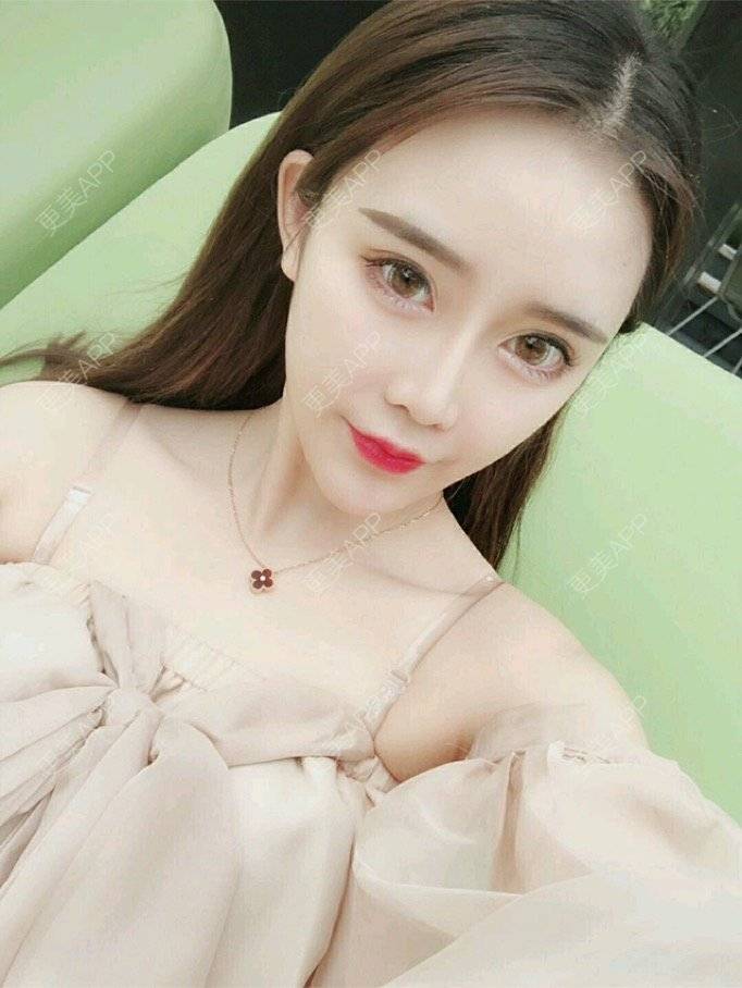 更美 - 怼怹恏尘的玻尿酸面部细纹经验 | 玻尿酸面部细纹 | 杭州