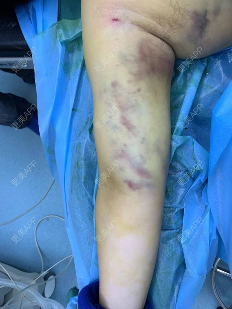 更美用户d7pau8vuy4的手臂吸脂日记