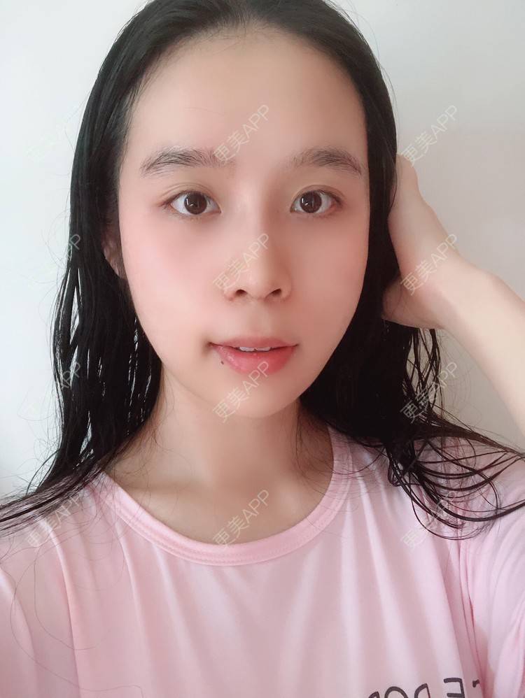 更美 - 超级超级好吃的下巴经验 | 膨体垫下巴 | 硅胶垫下巴 | 人工骨垫下巴 | 胶原蛋白丰下巴 | 玻尿酸下巴 | 自体脂肪垫下巴