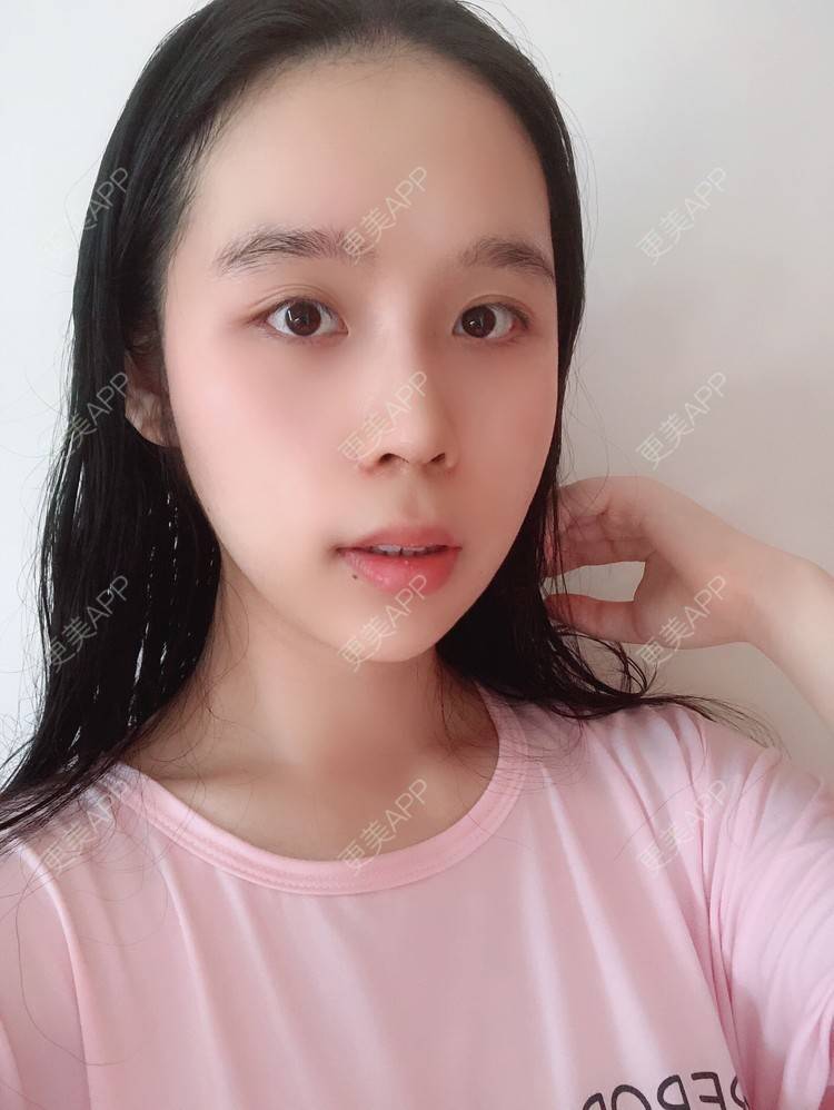 更美 - 超级超级好吃的下巴经验 | 膨体垫下巴 | 硅胶垫下巴 | 人工骨垫下巴 | 胶原蛋白丰下巴 | 玻尿酸下巴 | 自体脂肪垫下巴