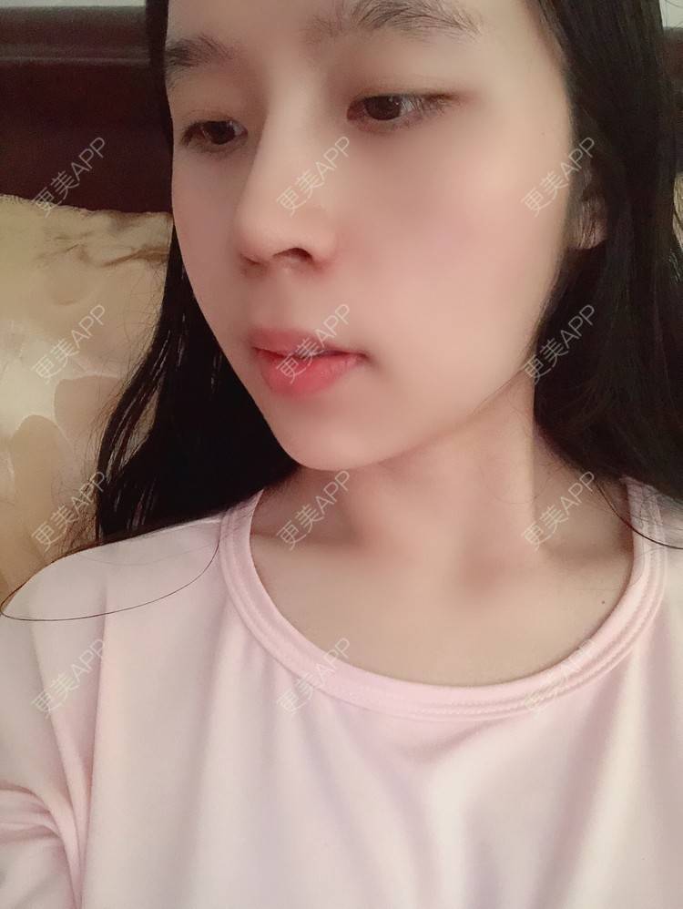 更美 - 超级超级好吃的下巴经验 | 膨体垫下巴 | 硅胶垫下巴 | 人工骨垫下巴 | 胶原蛋白丰下巴 | 玻尿酸下巴 | 自体脂肪垫下巴