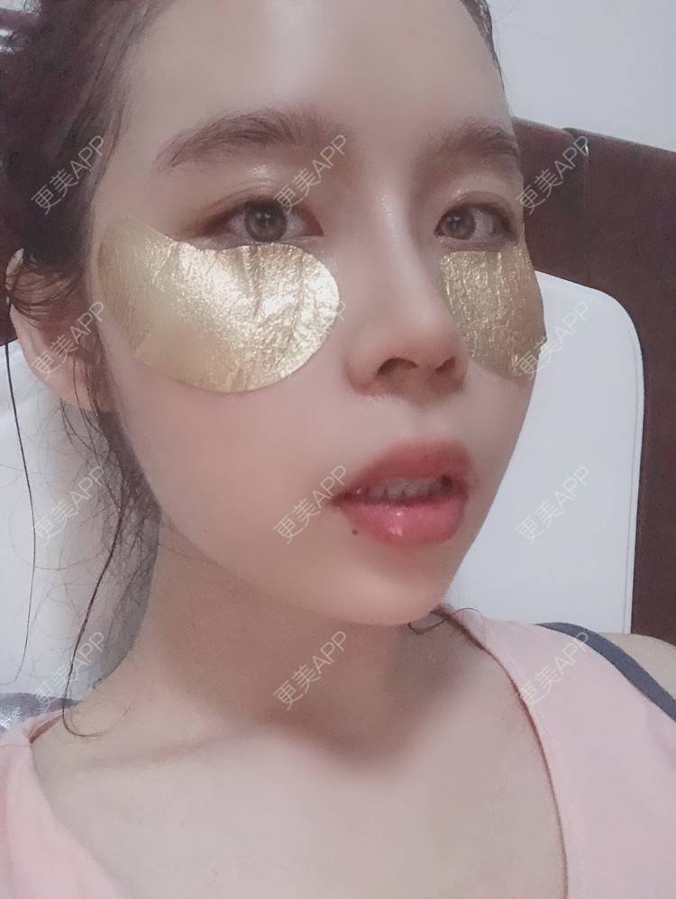 更美 - 超级超级好吃的下巴经验 | 膨体垫下巴 | 硅胶垫下巴 | 人工骨垫下巴 | 胶原蛋白丰下巴 | 玻尿酸下巴 | 自体脂肪垫下巴