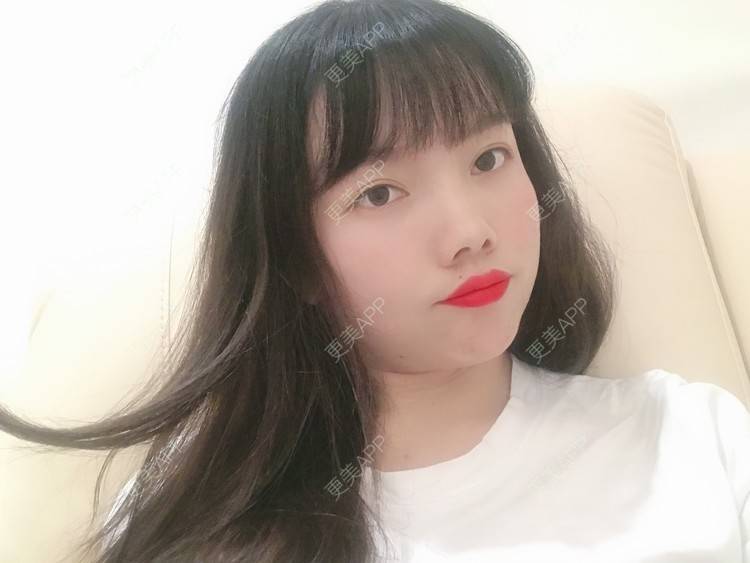 更美 - Amnot的自体脂肪丰面颊经验 | 自体脂肪丰面颊 | 自体脂肪丰太阳穴 | 重庆