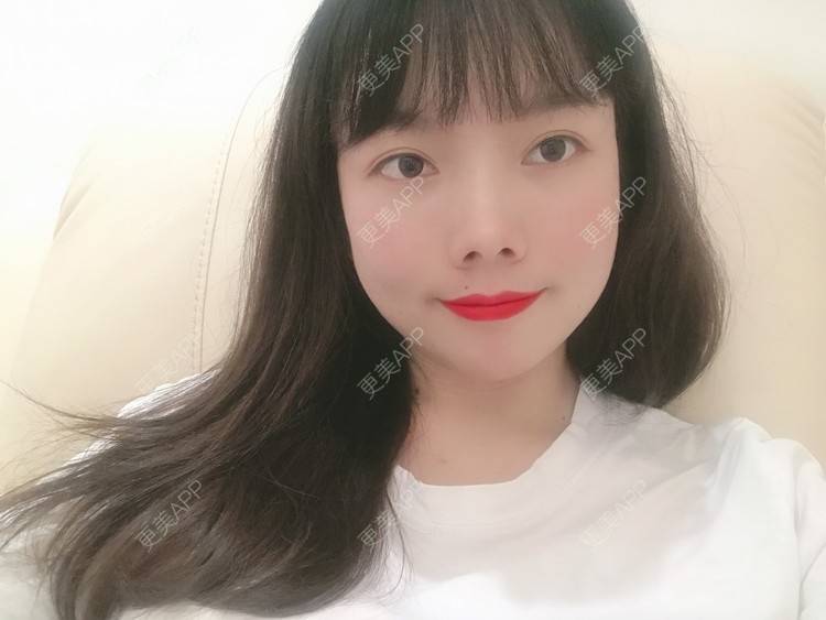 更美 - Amnot的自体脂肪丰面颊经验 | 自体脂肪丰面颊 | 自体脂肪丰太阳穴 | 重庆