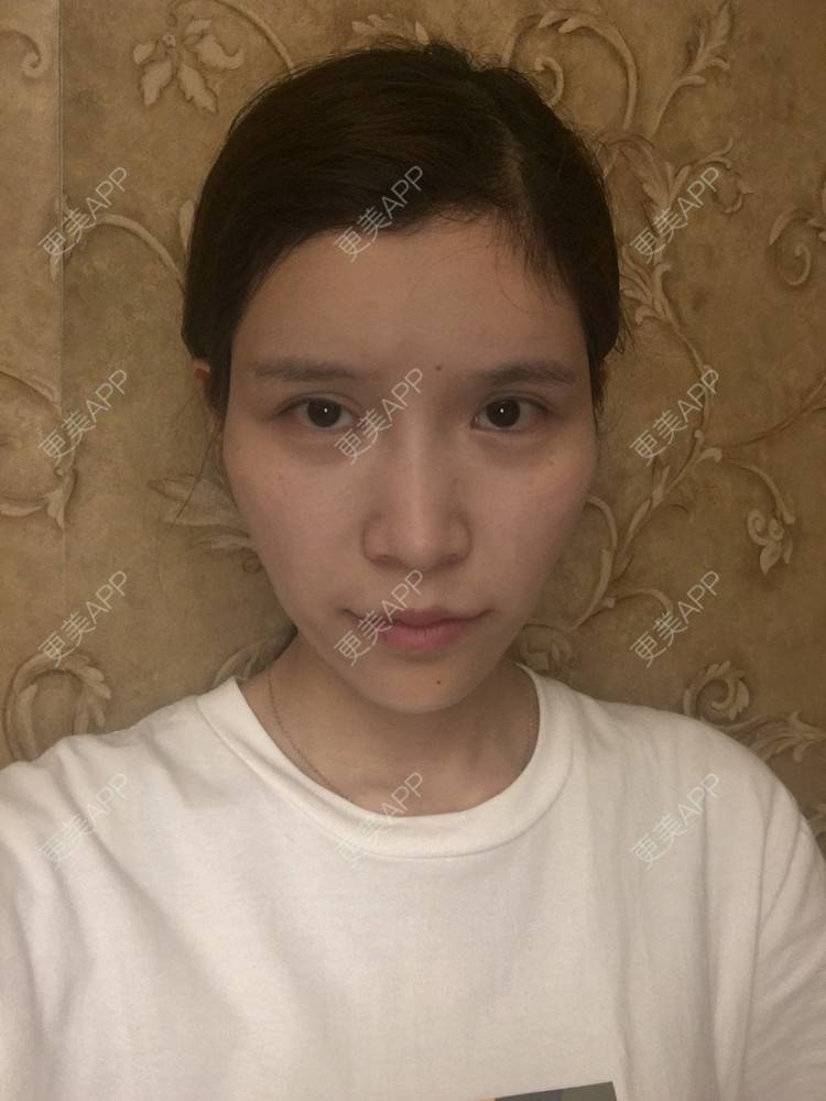 更美 - 橘子妹妹呀的自体脂肪填充泪沟经验 | 自体脂肪填充泪沟 | 自体脂肪丰苹果肌 | 自体脂肪丰面颊 | 自体脂肪丰太阳穴 | 武汉 | 自体脂肪全面部填充 | 自体脂肪面部填充 | 视频日记