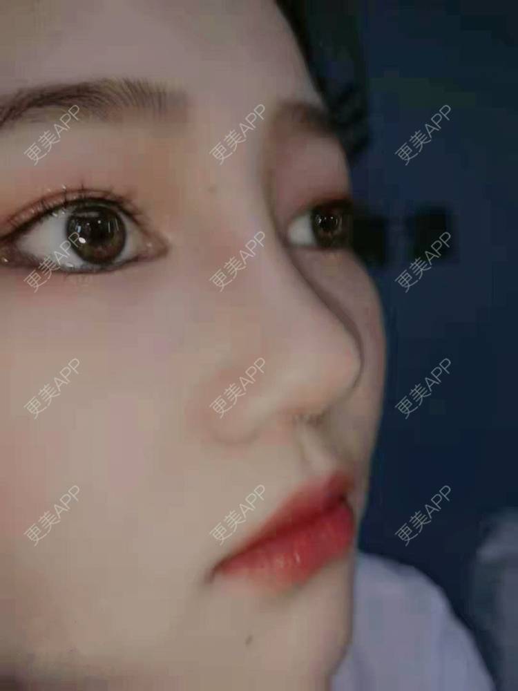 更美 - 花花cd的隆鼻经验 | 郑州 | 鼻部多项 | 隆鼻 | 鼻中隔软骨隆鼻 | 膨体隆鼻 | 鼻孔矫正