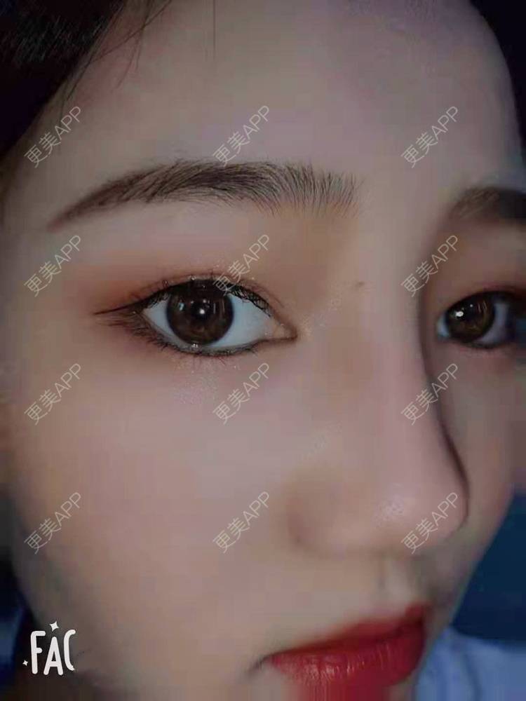 更美 - 花花cd的隆鼻经验 | 郑州 | 鼻部多项 | 隆鼻 | 鼻中隔软骨隆鼻 | 膨体隆鼻 | 鼻孔矫正