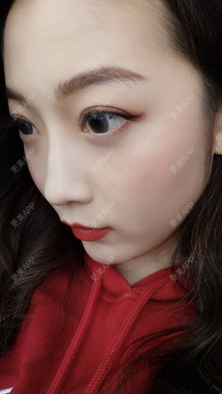 更美 - 更美用户5zukLulK2p的激光去眼袋经验 | 激光去眼袋
