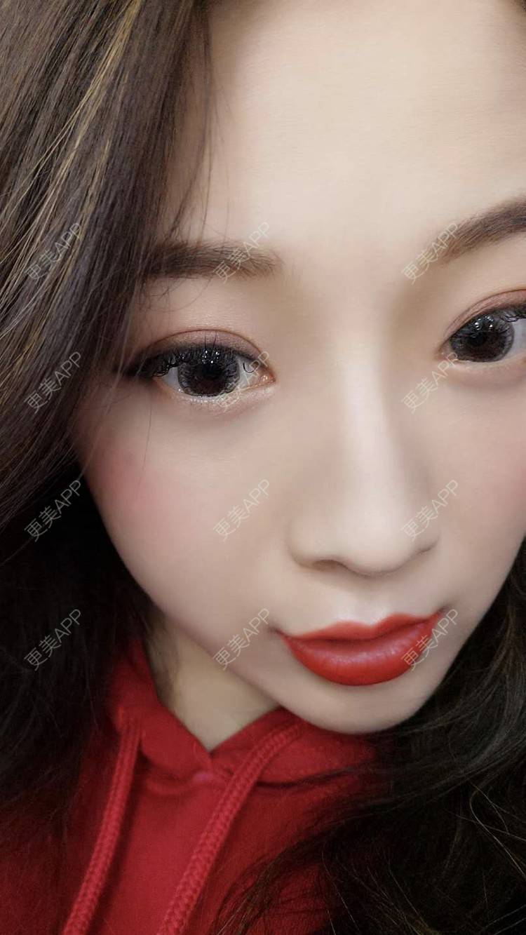 更美 - 更美用户5zukLulK2p的激光去眼袋经验 | 激光去眼袋