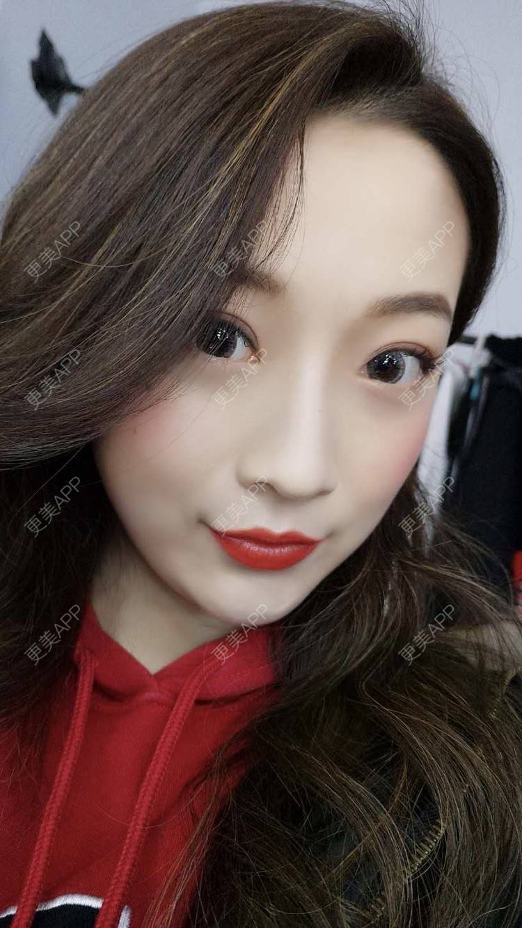 更美 - 更美用户5zukLulK2p的激光去眼袋经验 | 激光去眼袋