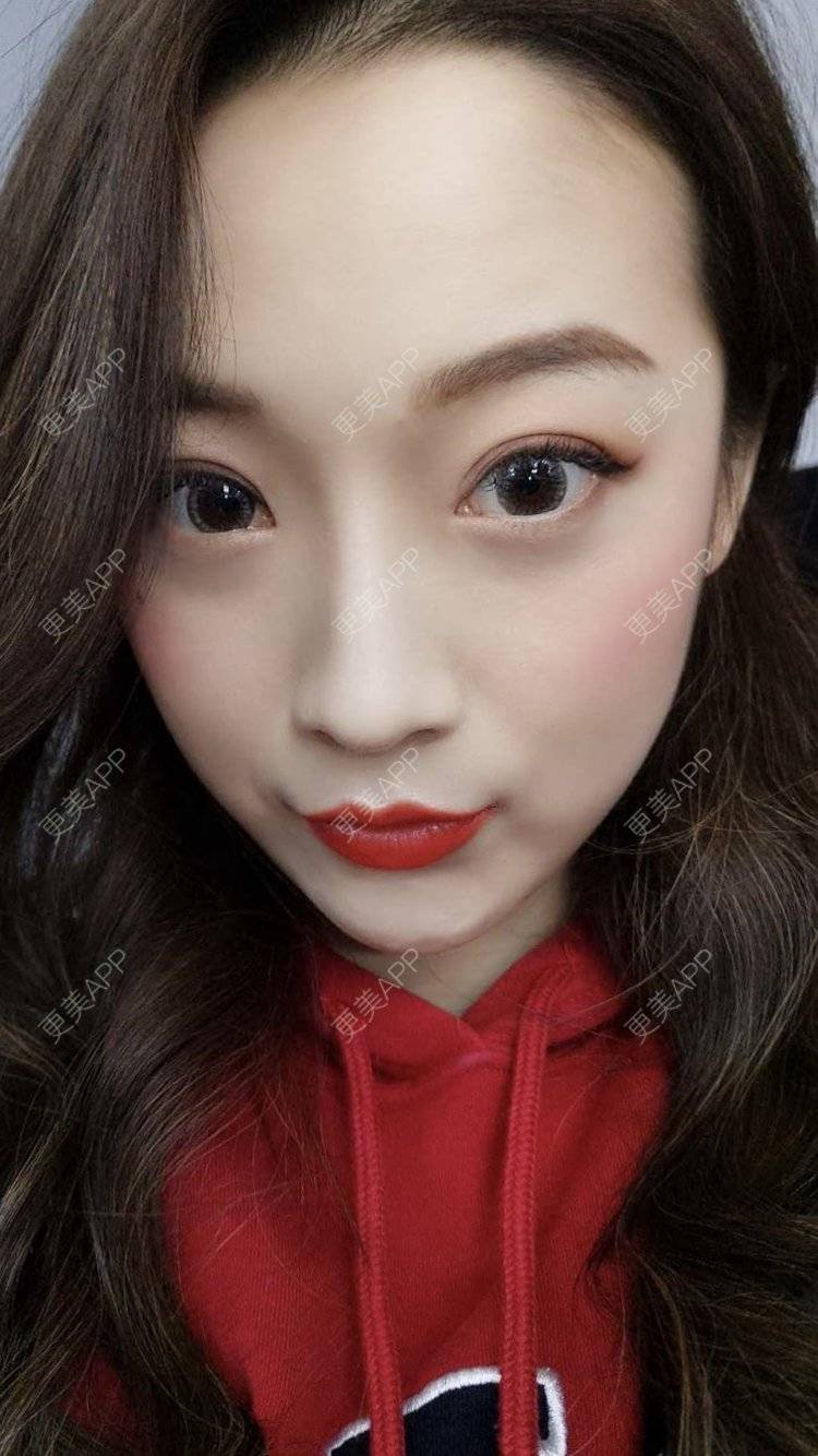 更美 - 更美用户5zukLulK2p的激光去眼袋经验 | 激光去眼袋