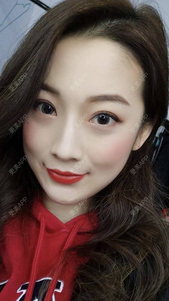 更美 - 更美用户5zukLulK2p的激光去眼袋经验 | 激光去眼袋