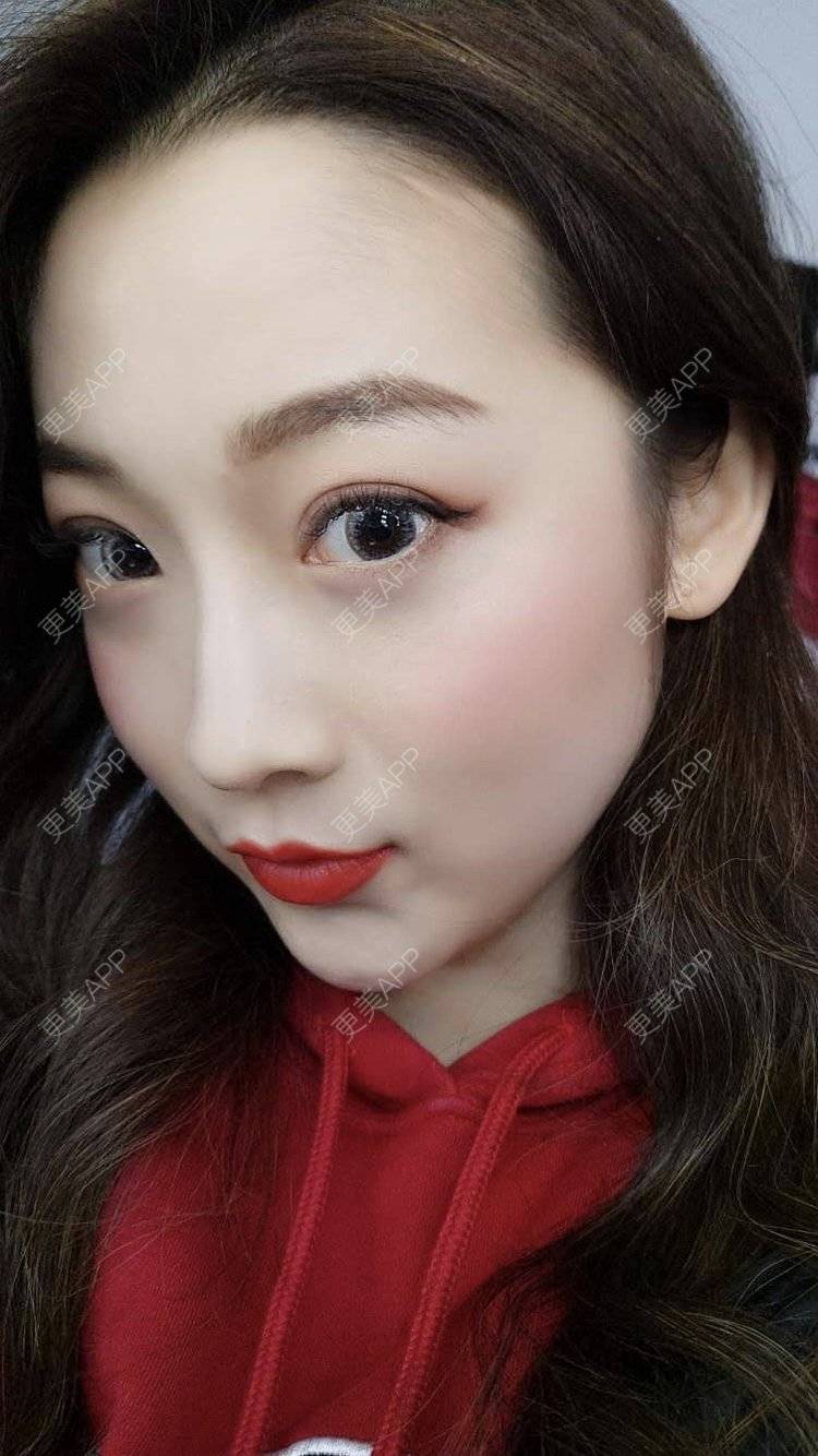 更美 - 更美用户5zukLulK2p的激光去眼袋经验 | 激光去眼袋
