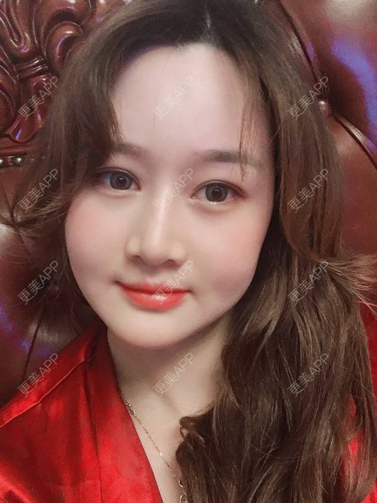 更美 - 小幸福快乐的经验 | 更美研究所 | 自体脂肪丰面颊 | 杭州 | 视频日记