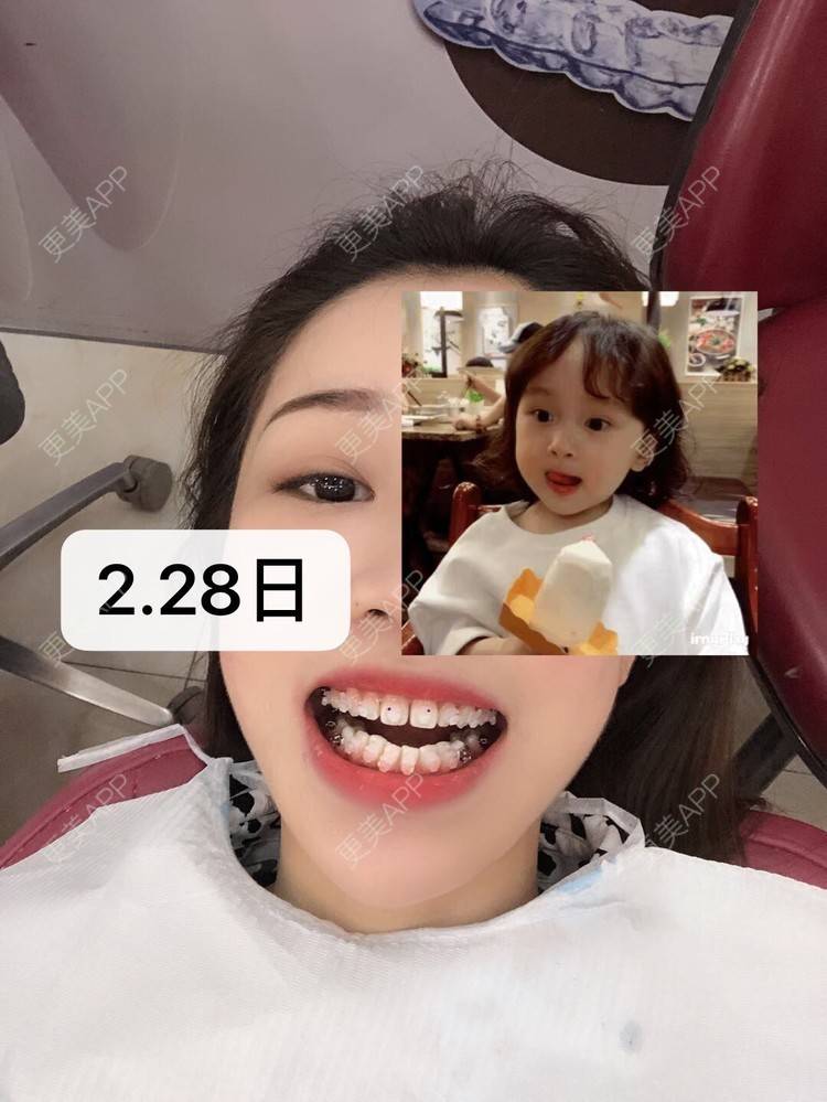 更美 - －Ｊane.’的牙齿矫正经验 | 牙齿矫正 | 广州