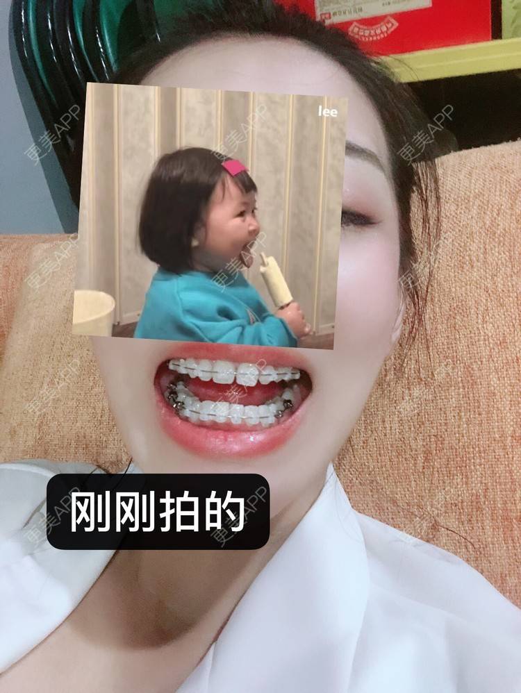 更美 - －Ｊane.’的牙齿矫正经验 | 牙齿矫正 | 广州