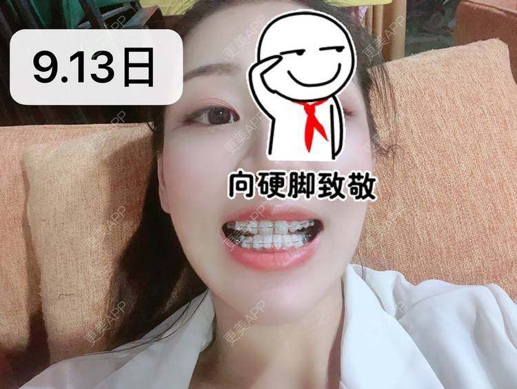 更美 - －Ｊane.’的牙齿矫正经验 | 牙齿矫正 | 广州