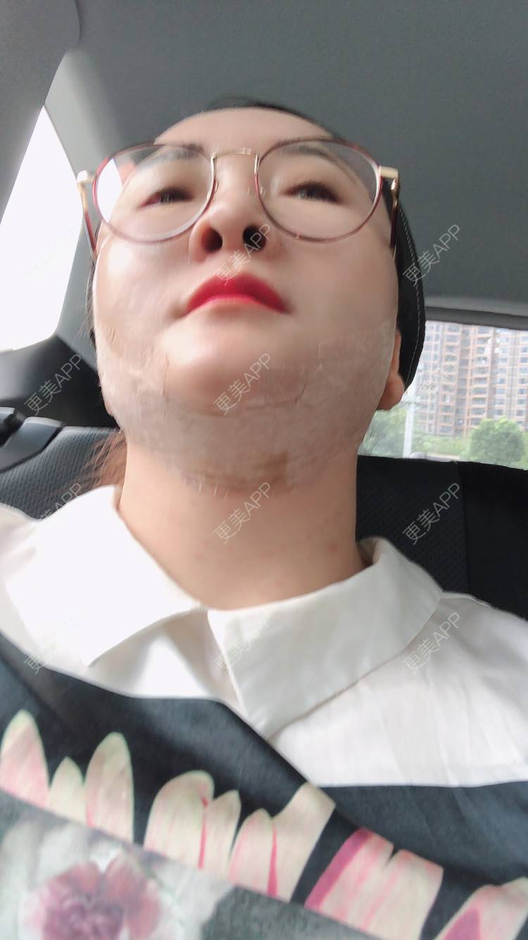 更美 - 花花福的玻尿酸颈纹经验 | 玻尿酸颈纹