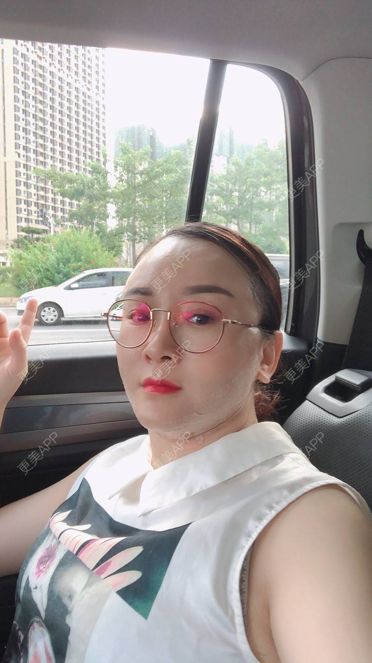 更美 - 花花福的玻尿酸颈纹经验 | 玻尿酸颈纹
