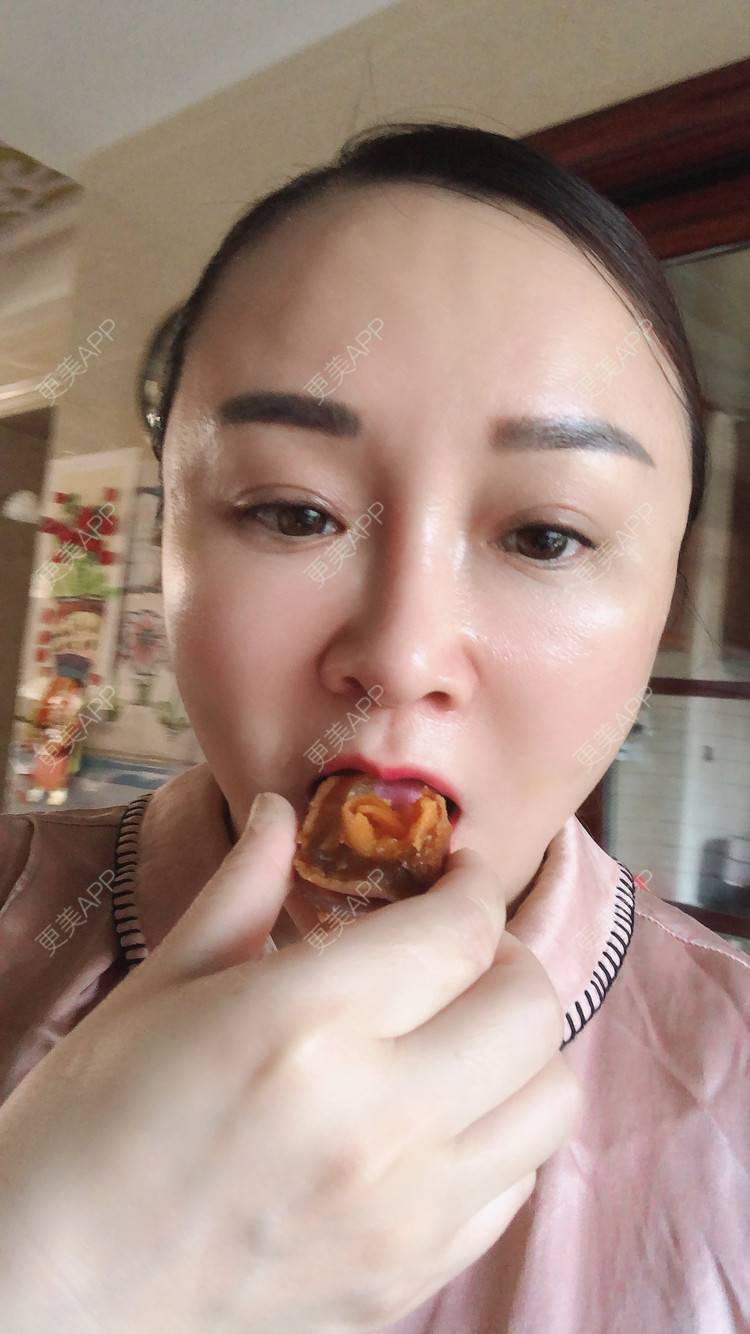 更美 - 花花福的玻尿酸颈纹经验 | 玻尿酸颈纹