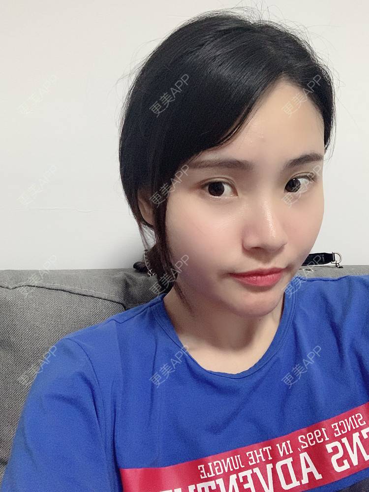 更美 - 大美人图的自体脂肪丰额头经验 | 更美研究所 | 自体脂肪丰额头 | 杭州