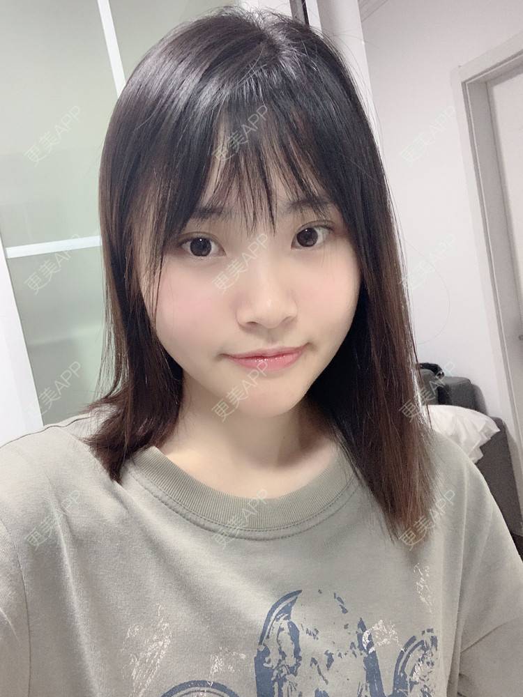 更美 - 大美人图的自体脂肪丰额头经验 | 更美研究所 | 自体脂肪丰额头 | 杭州