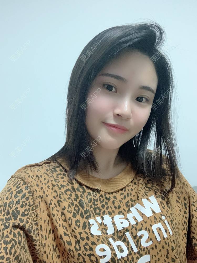 更美 - 大美人图的自体脂肪丰额头经验 | 更美研究所 | 自体脂肪丰额头 | 杭州