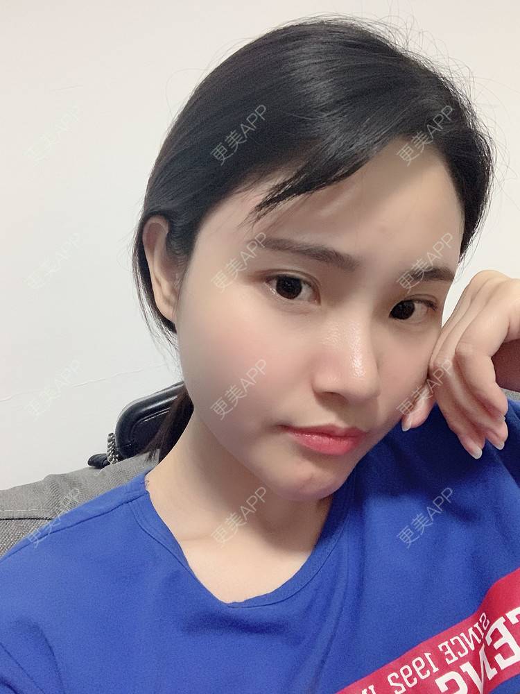 更美 - 大美人图的硅胶垫下巴经验 | 更美研究所 | 硅胶垫下巴 | 杭州