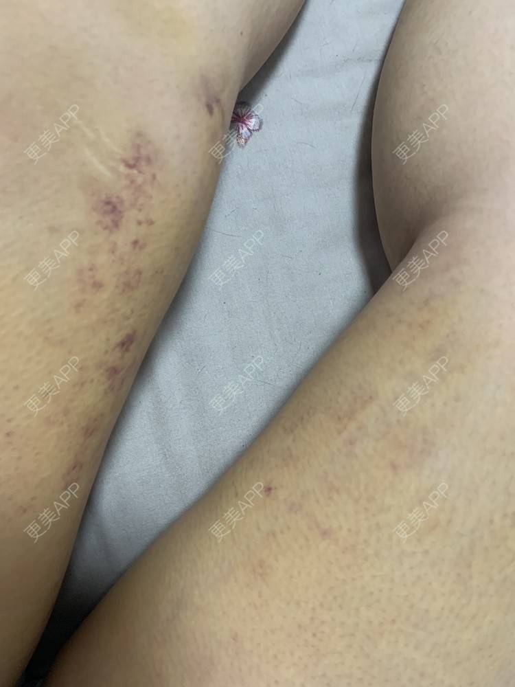 更美 - 更美用户JrJLC5yFo7的吸脂经验 | 吸脂 | 南京