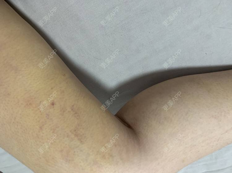 更美 - 更美用户JrJLC5yFo7的吸脂经验 | 吸脂 | 南京