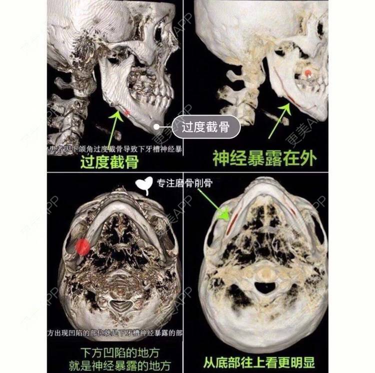 更美 - GH更美cc_的颧骨内推经验 | 颧弓降低 | 颧骨填充 | 颧骨提高 | 颧骨内推 | 上海