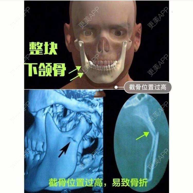 更美 - GH更美cc_的颧骨内推经验 | 颧弓降低 | 颧骨填充 | 颧骨提高 | 颧骨内推 | 上海