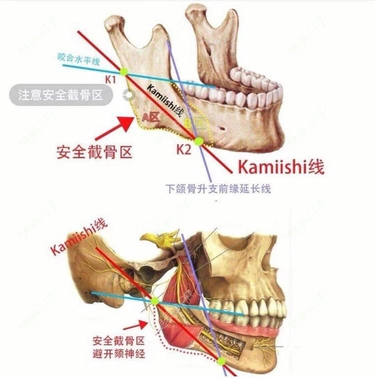 更美 - GH更美cc_的颧骨内推经验 | 颧弓降低 | 颧骨填充 | 颧骨提高 | 颧骨内推 | 上海