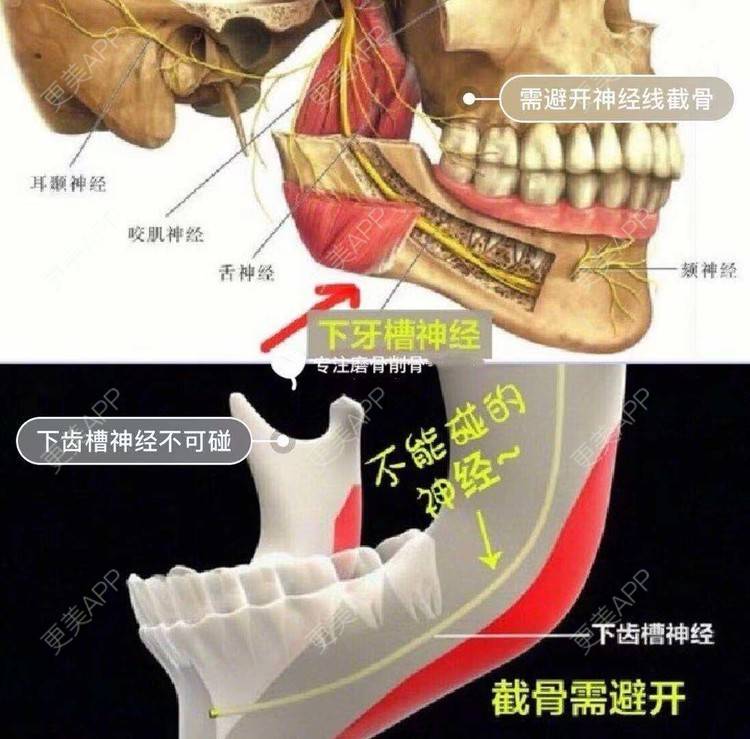 更美 - GH更美cc_的颧骨内推经验 | 颧弓降低 | 颧骨填充 | 颧骨提高 | 颧骨内推 | 上海