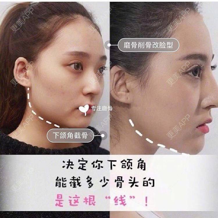 更美 - GH更美cc_的颧骨内推经验 | 颧弓降低 | 颧骨填充 | 颧骨提高 | 颧骨内推 | 上海